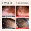 image:imageiRESTORE Scalp Serum  Hair Growth Serum for Women Men  Best for Hair Loss Hair Thinning  Aids Regrowth with Redensyl Capixyl amp Biotin  Hydrates Scalp for Visibly Thicker Fuller Hair  2 Fl Oz2 Fl Oz Pack of 3