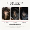 image:imageiRestore Hair Growth Supplement  Hair Loss Vitamins for Women and Men  Biotin Multivitamins amp DHT Blocker to Reduce Hair Thinning  Hair Regrowth Pills  30 Days Supply 90 Count Pack of 190 Count Pack of 1