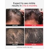 image:imageiRestore Professional Laser Red Light Therapy for Hair Growth System  FDA Cleared Hair Loss Hair Thinning amp Alopecia Treatment for Men amp Women  282 Lasers amp LEDsiRestore Professional